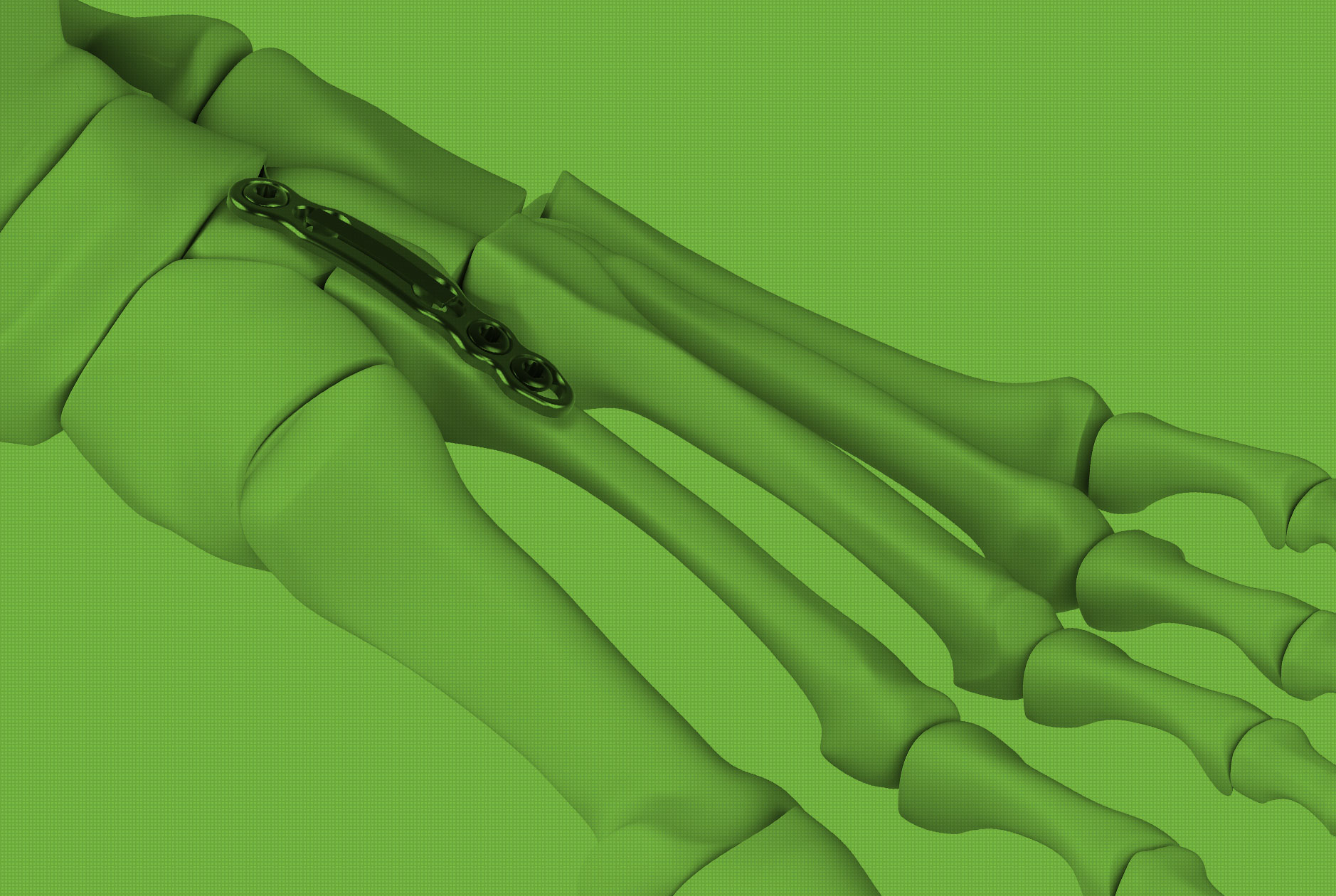 TMT Implant System