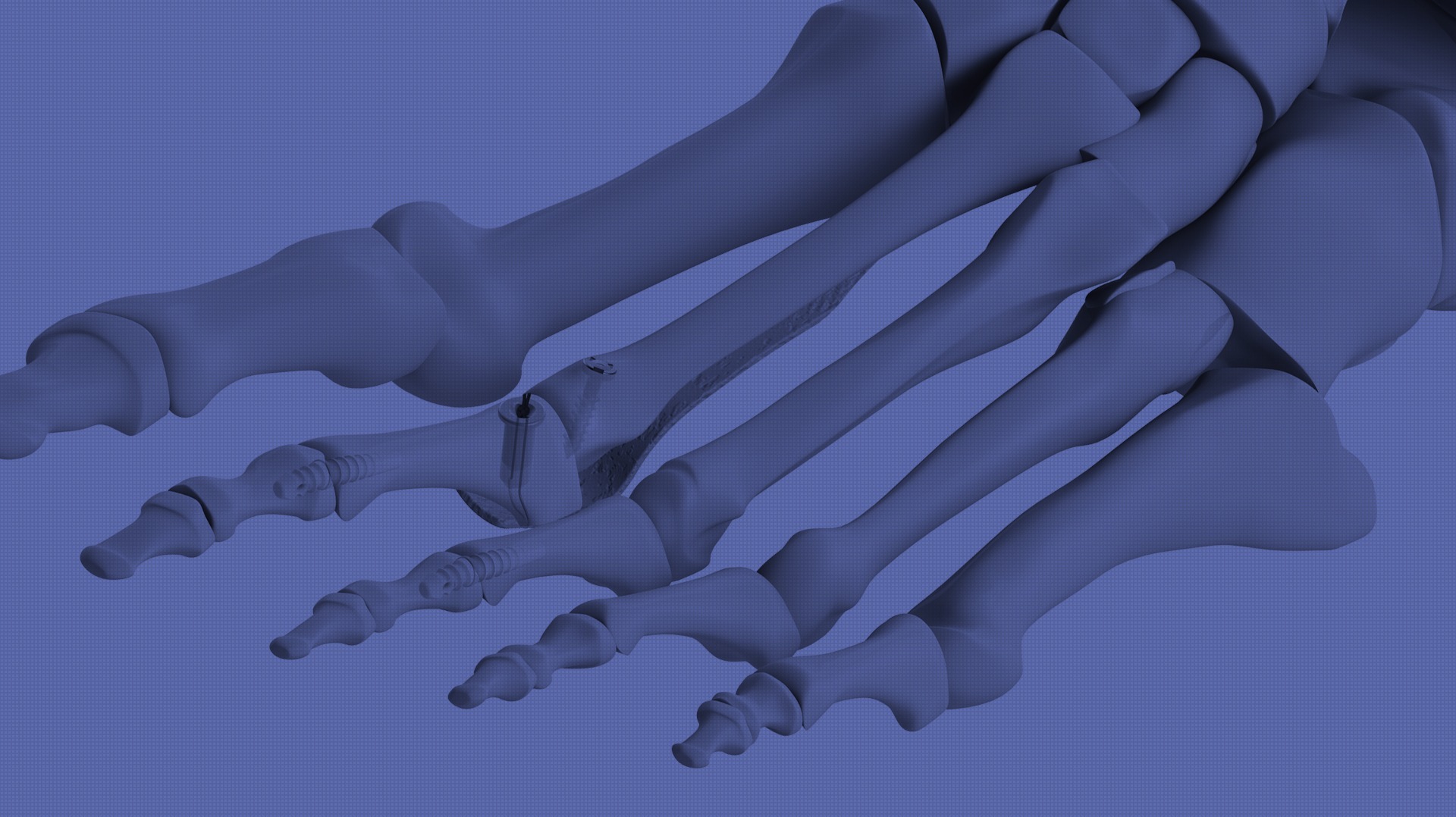 STRoPP Medical Implant