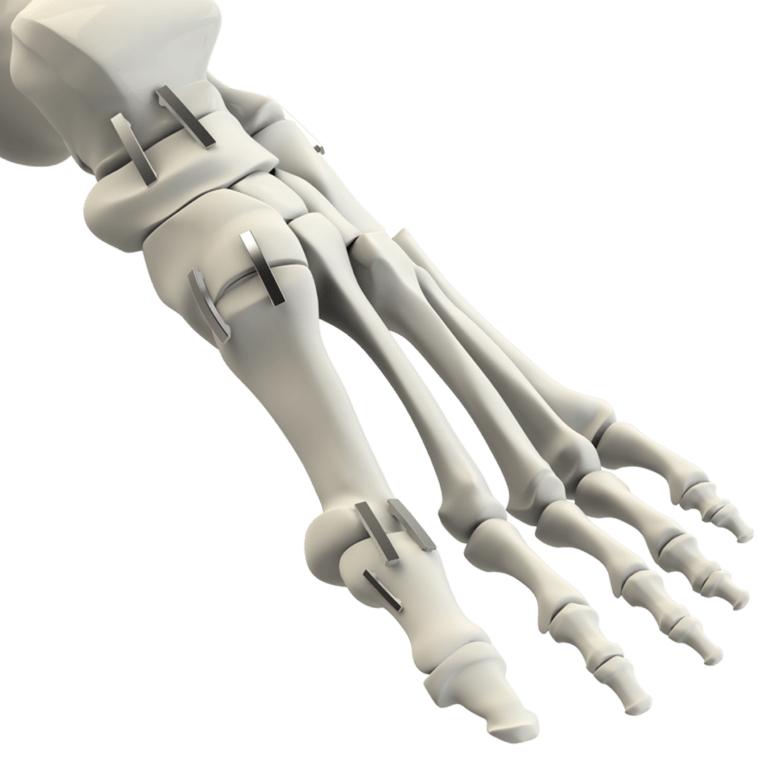 Clips Continuous Compression Implants