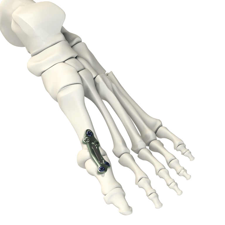MPJ Implant System