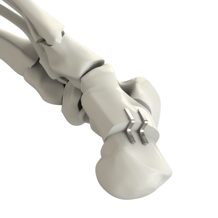 Step Staple Continuous Compression Implants