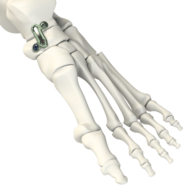 T/N Fusion Hybrid Implant System