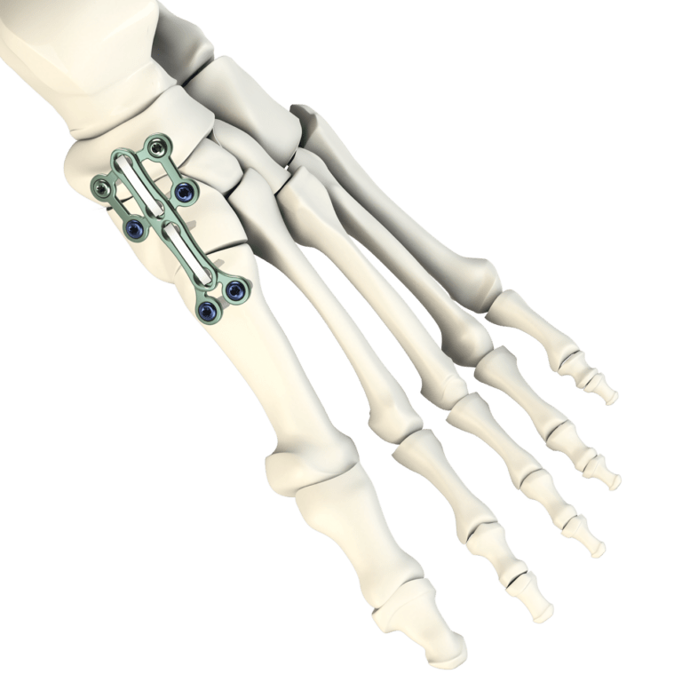 Vero Medial Column Fusion