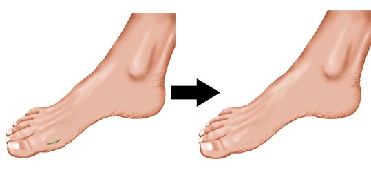 MiniBunion Procedure Scarring