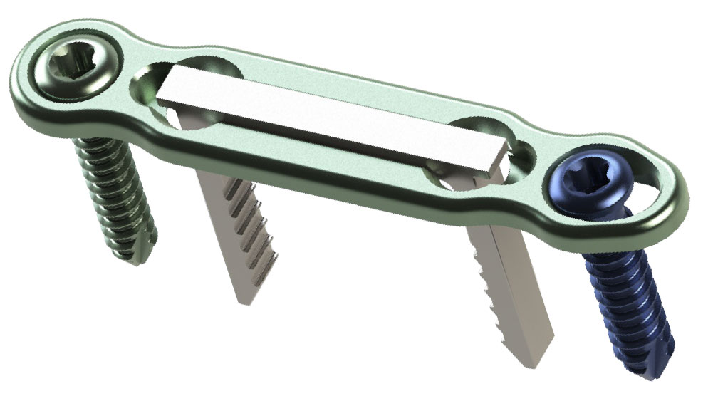 Tarsometatarsal Fusion with DynaForce