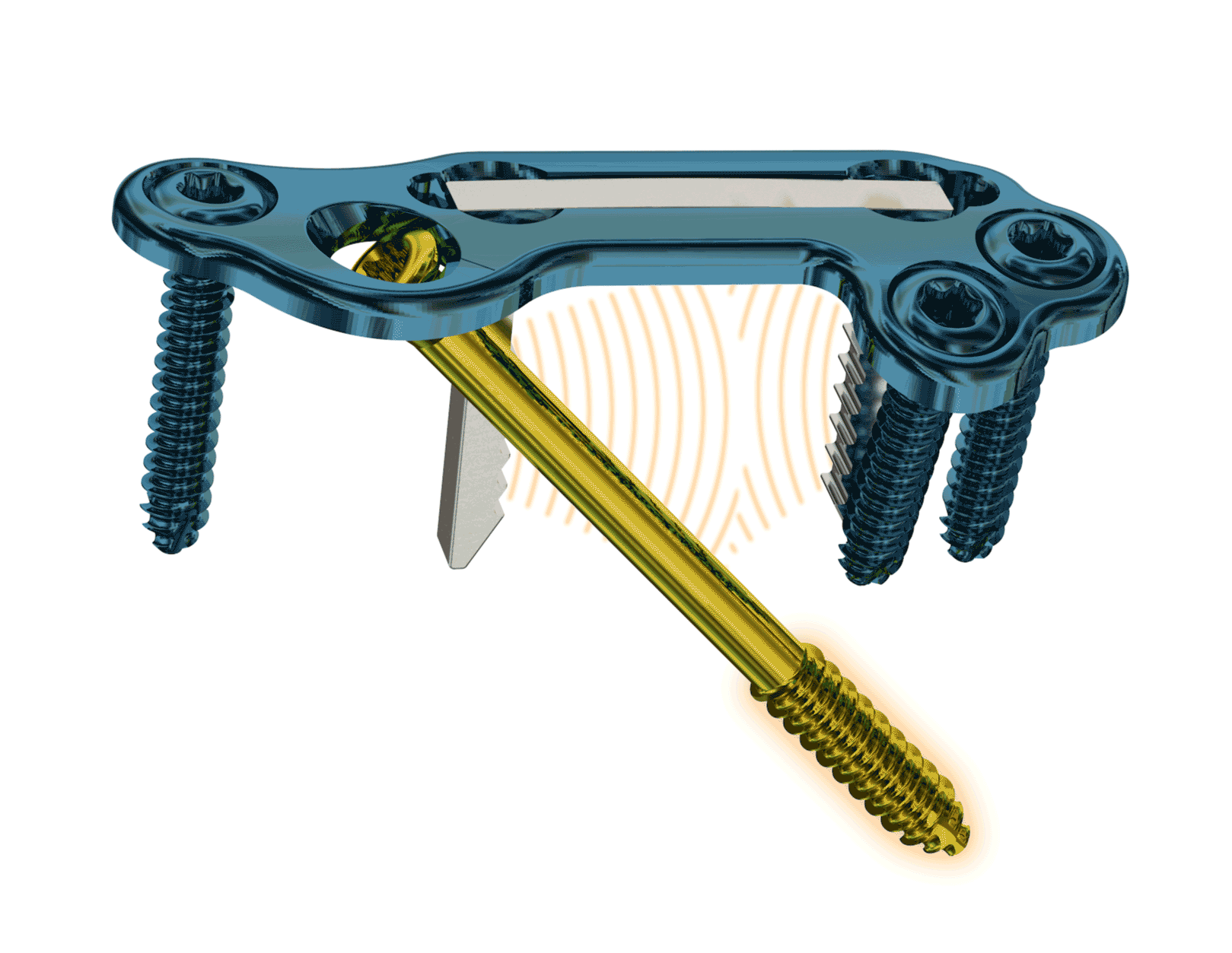 DynaBunion_NoBones-Corp-Website-Homepagehorizontal Keel-Lock Plate Stability with Staple Simplicity