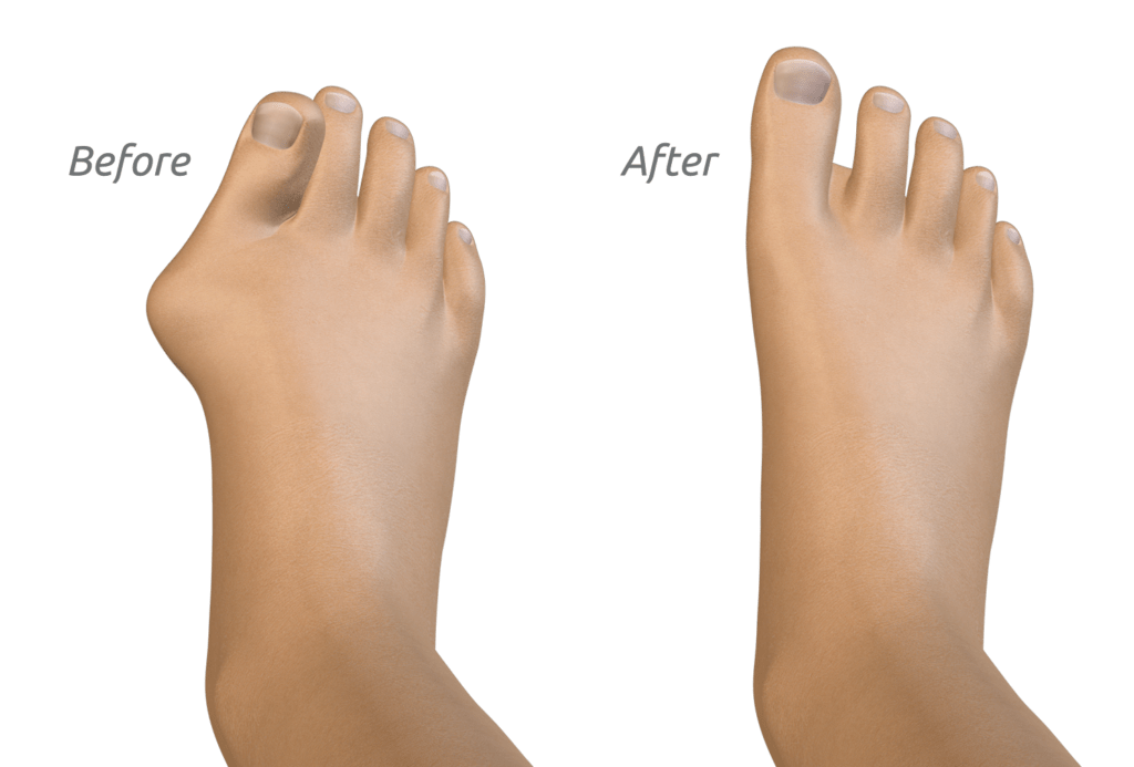 Optimize Healing and Preserve Toe Length
