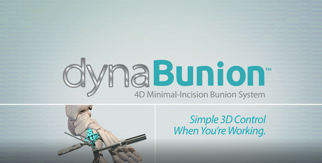 CrossRoads® Extremity Systems, LLC Announces Launch Of The DynaBunion™ 4D Minimal-Incision Lapidus System For Bunion Corrections