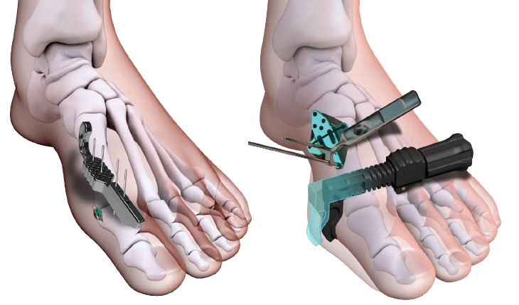 new-acfas-image MIS Distal Bunion Lab February 10th and 4D Instrumented Lapidus Lab February 11th.