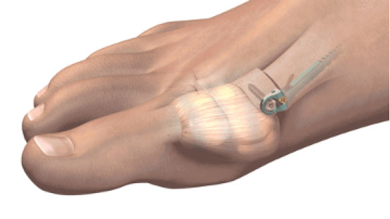 MiniBunion Preserves the Joint Capsule