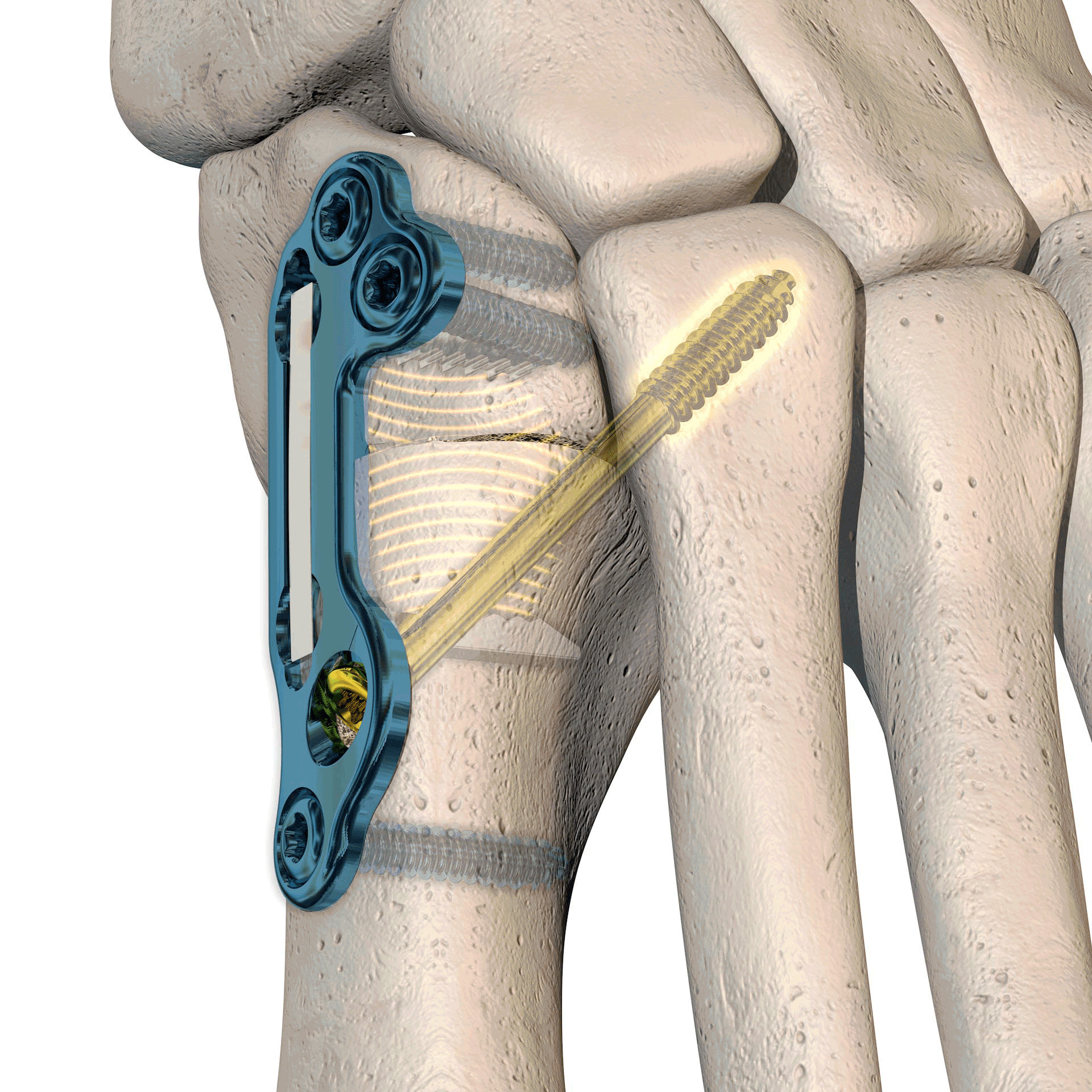 One and Done Bunion Correction One and Done Bunion Correction