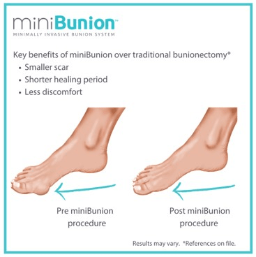 Key benefits of miniBunion over traditional bunionectomy