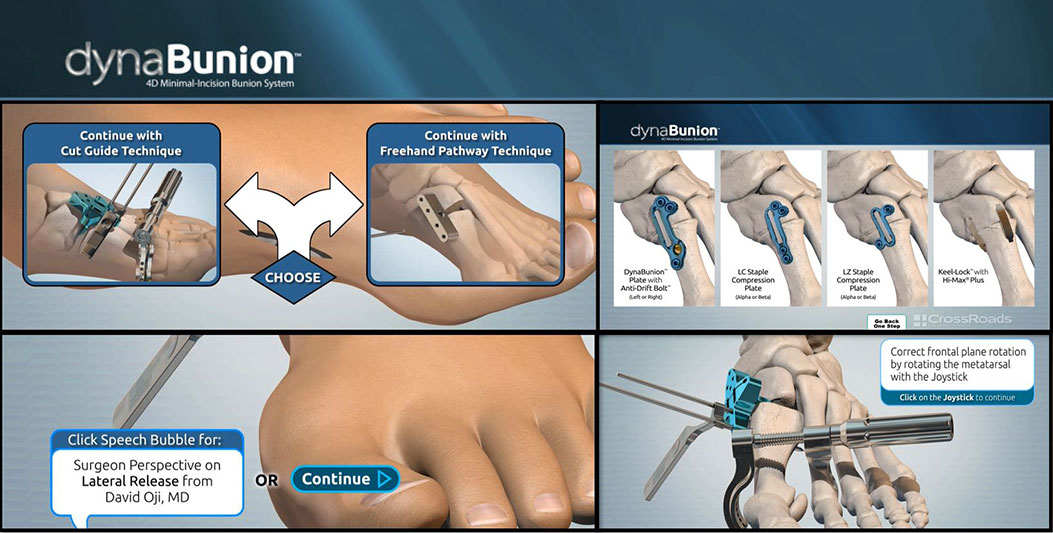 DynaBunion Interactive Animation